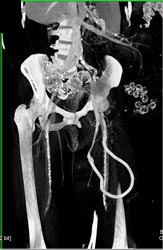 Av Fistulae Pelvis - CTisus CT Scan