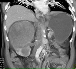 Renal Cell Carcinoma Invades the Inferior Vena Cava (IVC) and Renal Vein - CTisus CT Scan