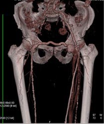 Graft From External Iliac Artery to Anterior Tibial Artery - CTisus CT Scan