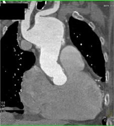 Dilated Ascending Aorta - CTisus CT Scan