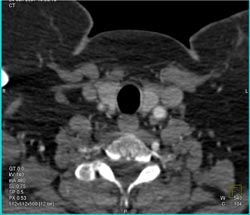 ??? Right Cartotid Artery - CTisus CT Scan