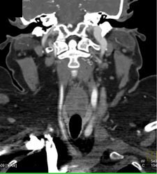 Patent Carotid Artery on Left - CTisus CT Scan