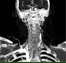 Occluded Right Common Carotid Artery - CTisus CT Scan