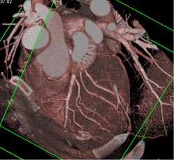 Normal Coronary Artery - CTisus CT Scan