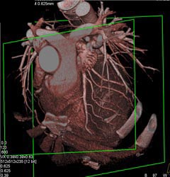 Normal Coronary Artery - CTisus CT Scan