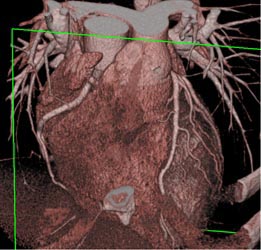 Normal Coronary Artery - CTisus CT Scan