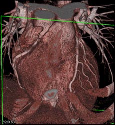 Normal Coronary Artery - CTisus CT Scan