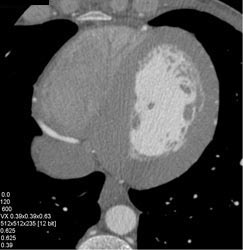 Normal Coronary Artery - CTisus CT Scan