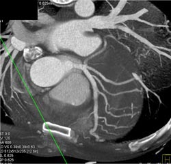 Normal Coronary Artery - CTisus CT Scan