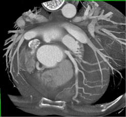 Normal Coronary Artery - CTisus CT Scan