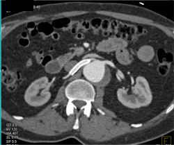 Stent in Right Renal Artery - CTisus CT Scan