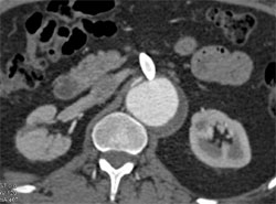 Patent Stent in SMA - CTisus CT Scan