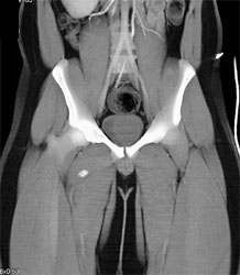 Pseudoaneurysm Off the SFA - CTisus CT Scan