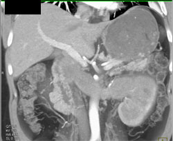 Renal Cell Carcinoma- Extends Into the Renal Vein and IVC - CTisus CT Scan