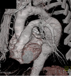 Aneurysm of Descending Thoracic Aorta - CTisus CT Scan