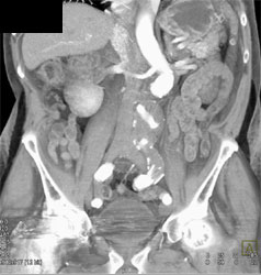 Endoleak - CTisus CT Scan