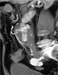 Endoleak - CTisus CT Scan