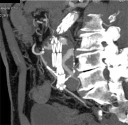 Endoleak - CTisus CT Scan