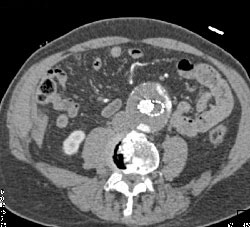 Endoleak - CTisus CT Scan