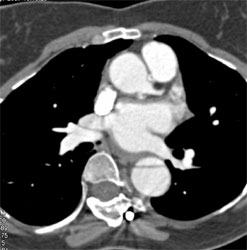 Type B Dissection - CTisus CT Scan