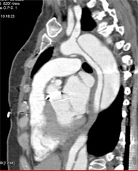 Type B Dissection - CTisus CT Scan