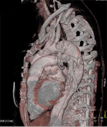 Type B Dissection - CTisus CT Scan