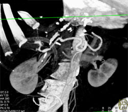 Hepatic Artery Stenosis at the Anastomosis - CTisus CT Scan