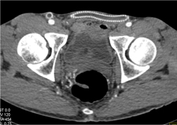 Occluded Fem-fem Graft - CTisus CT Scan