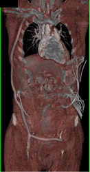 Occluded Fem-fem Graft and Occlusion of IVC - CTisus CT Scan