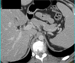 Chronic IVC Occlusion With Collaterals - CTisus CT Scan