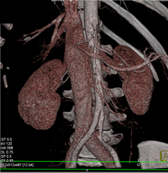 Inferior Vena Cava (IVC) Reflux - CTisus CT Scan