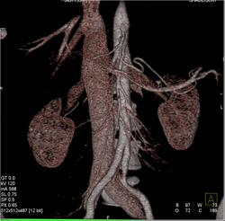 IVC Reflux Shown With VRT and MIP - CTisus CT Scan