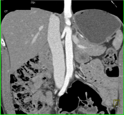 Inferior Vena Cava (IVC) Reflux - CTisus CT Scan