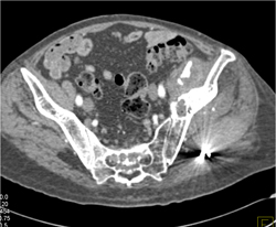 Embolization to Buttocks to Stop Bleed S/P Bone Fracture - CTisus CT Scan