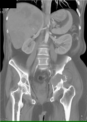 Lytic Lesion Acetabulum and Liver Mets - CTisus CT Scan