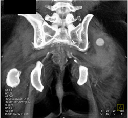 Active Bleed S/P Fracture - CTisus CT Scan