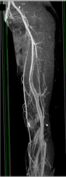 Normal Runoff in Various Renderings - CTisus CT Scan