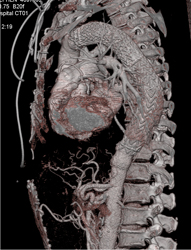 Stent in Thoracic Aneurysm - CTisus CT Scan