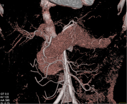 Gastroduodenal Artery (GDA) Swings Over Pancreas - CTisus CT Scan