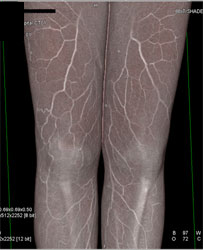 Lighting Models Show Off Surface of Thigh - CTisus CT Scan