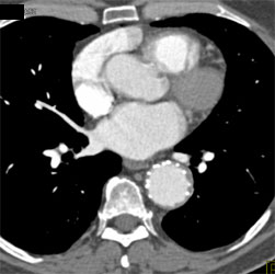 Stent in Descending Aorta - CTisus CT Scan