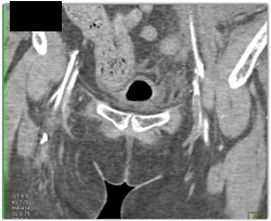 Deep Vein Thrombosis (DVT) Left Femoral Vein - CTisus CT Scan