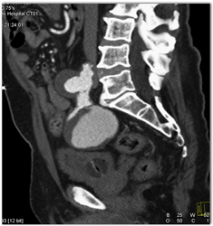 Internal Iliac Aneurysms - CTisus CT Scan