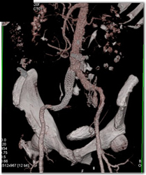 Stent Repair of Aneurysm - CTisus CT Scan