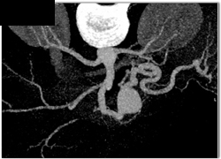 Splenic Artery Aneurysm - CTisus CT Scan