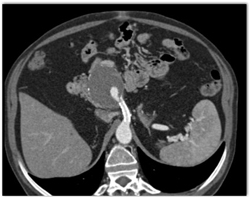 SMA Aneurysm With Stent in SMA - CTisus CT Scan