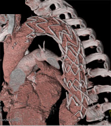 Endovascular Stent in Patient Post-repair - CTisus CT Scan