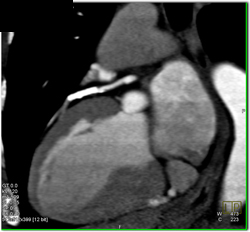 Stent in LAD - CTisus CT Scan