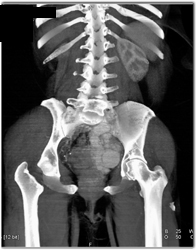 Av Fistulae in Pelvis - CTisus CT Scan