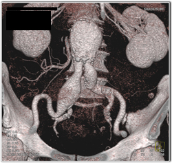 Abdominal Aortic Aneurysm (AAA) of Iliac Artery Aneurysm - CTisus CT Scan